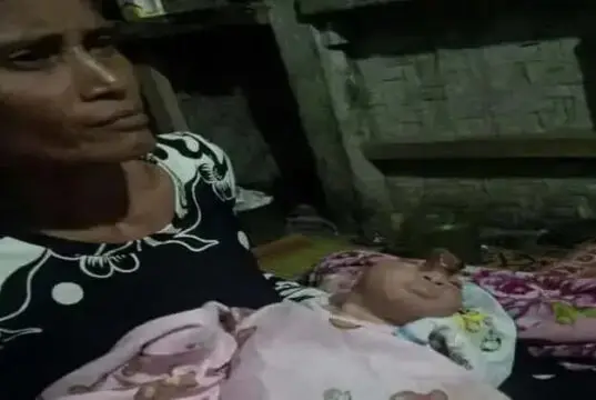 Bayi Lahir Tanpa Tempurung Kepala di Pandeglang Bayi Lahir Tanpa Tempurung Kepala di Pandeglang