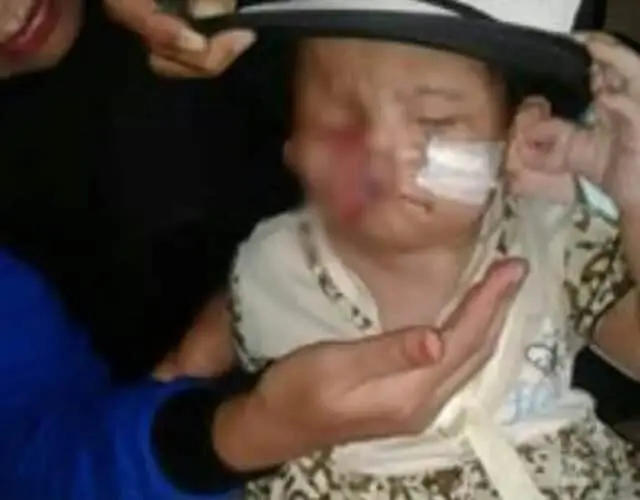 Terlahir Cacat di Bagian Wajah, Bayi Laura Butuh Pertolongan Terlahir Cacat di Bagian Wajah, Bayi Laura Butuh Pertolongan