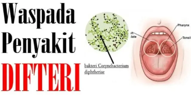 Bahaya Penyakit Difteri Satu Pasien Dinyatakan Meninggal di RSUD Tangerang Bahaya Penyakit Difteri Satu Pasien Dinyatakan Meninggal di RSUD Tangerang