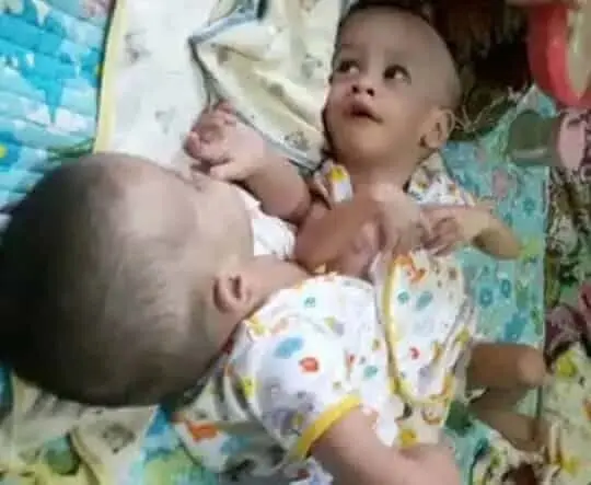 1 Milyar, Bayi Kembar Siam di Tangerang Segera Operasi 1 Milyar, Bayi Kembar Siam di Tangerang Segera Operasi